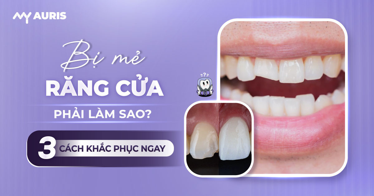 bị mẻ răng cửa,bị mẻ răng cửa là điềm gì,bị mẻ răng cửa phải làm sao