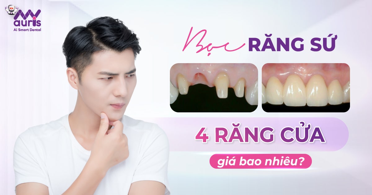 [Giải đáp] Bọc răng sứ 4 răng cửa giá bao nhiêu?