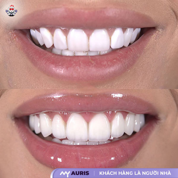 bọc răng sứ có ăn đồ cứng được không
