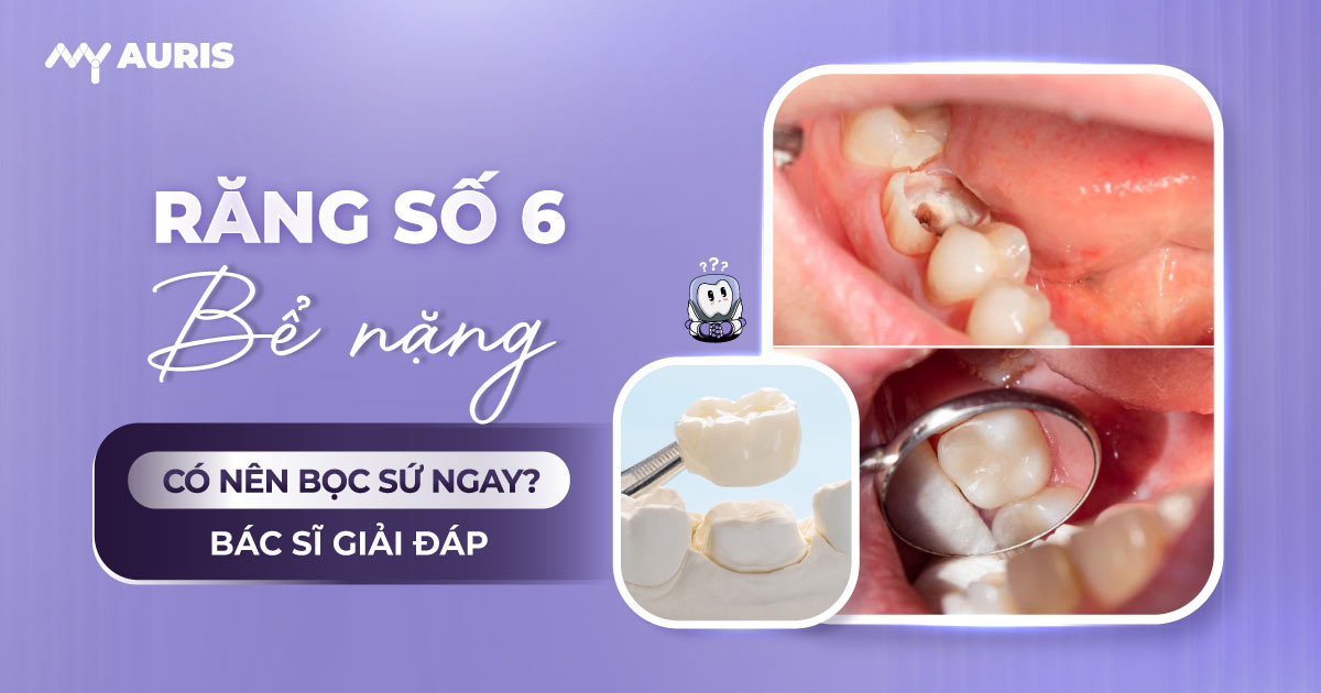 Bọc răng sứ số 6
