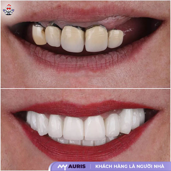 bọc sứ 4 răng cửa giá bao nhiêu