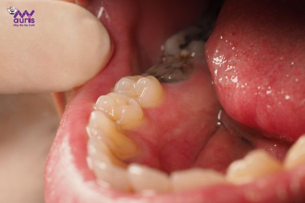 cách nhổ răng hàm bị sâu tại nhà 