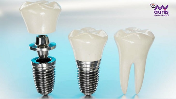 cấy răng implant uy tín