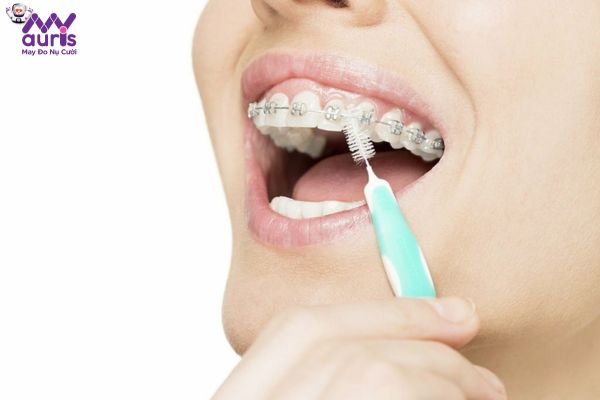 Những trường hợp nào được chỉ định thực hiện niềng răng một hàm 