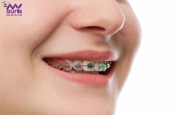 Giải đáp nha khoa: Có thể niềng răng một hàm được không?