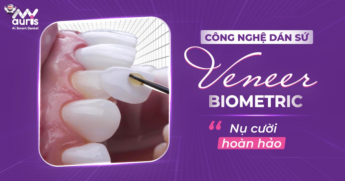 Công nghệ dán sứ veneer biometric