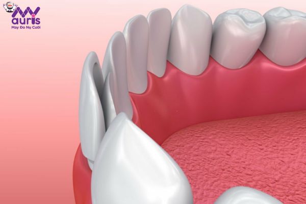 Ưu điểm giúp phương pháp dán răng sứ phổ biến trong nha khoa