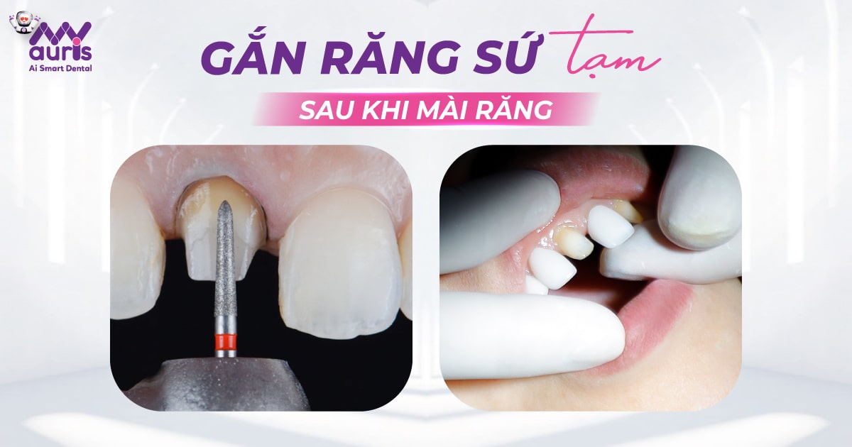 Gắn răng sứ tạm sau khi mài răng - 4 bước thực hiện