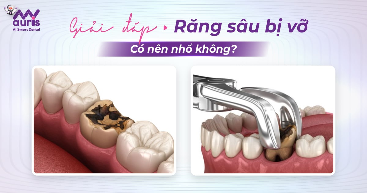 Răng sâu bị vỡ có nên nhổ không?