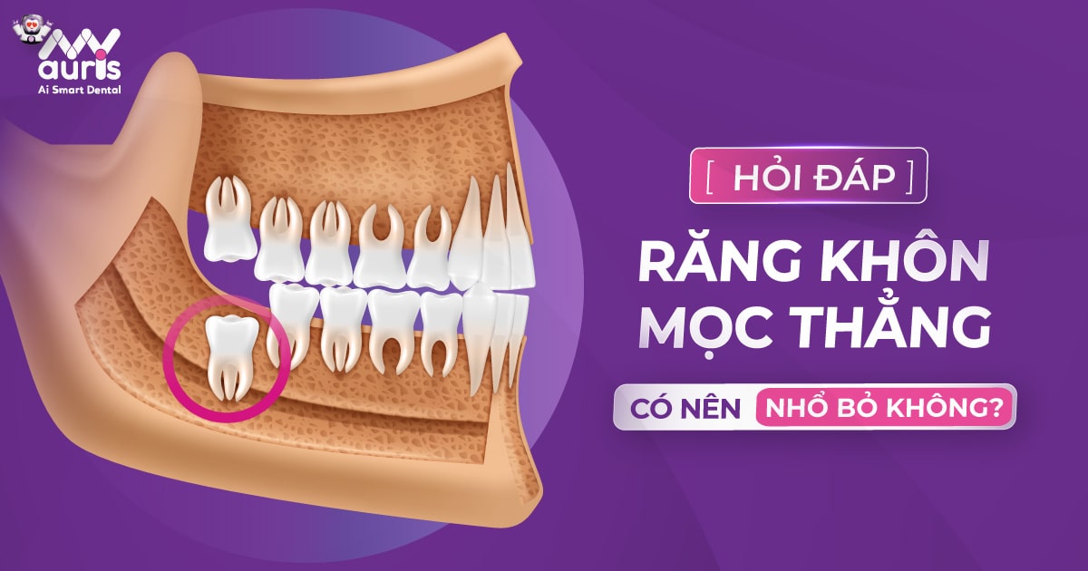 Răng khôn mọc thẳng có nên nhổ bỏ không?