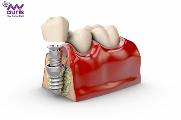 Trường hợp chống chỉ định thực hiện trồng răng Implant 