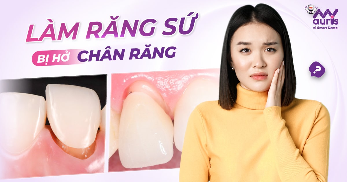 Làm răng sứ bị hở chân răng - 5 nguyên nhân chính