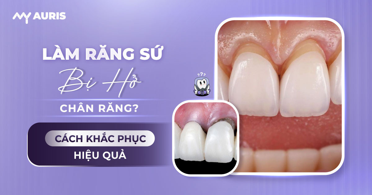 làm răng sứ bị hở chân răng,làm răng sứ bị hở