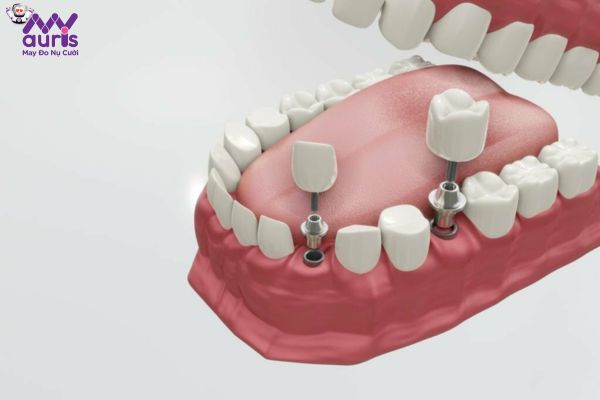 Chia sẻ nhổ răng bao lâu thì có thể cấy Implant?
