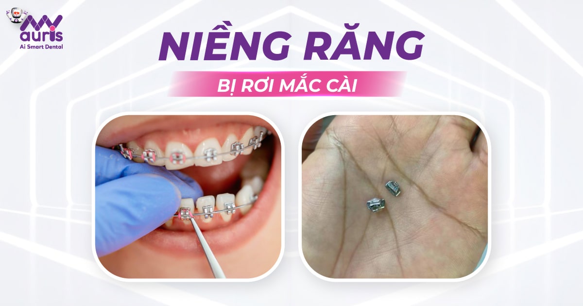 Niềng răng bị rơi mắc cài - 5 nguyên nhân chính