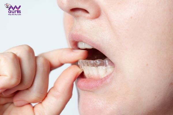 Niềng răng hàm trong suốt có cần nhổ răng không?