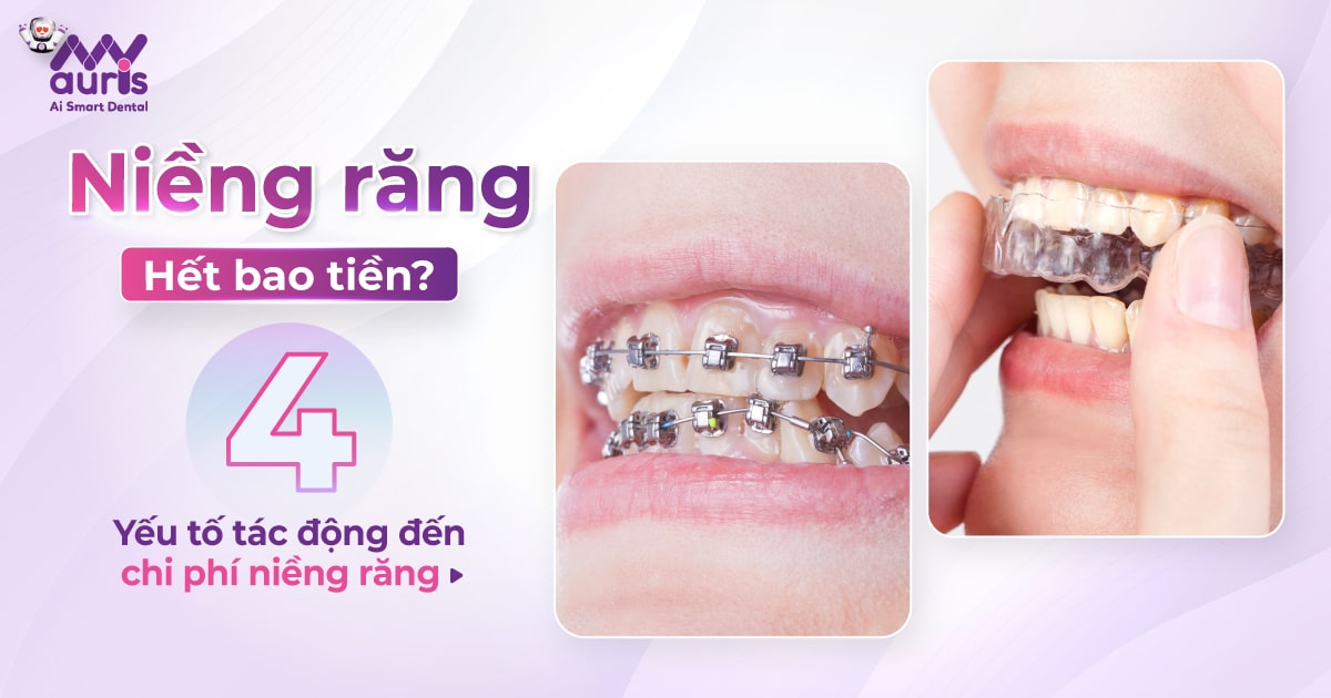 Niềng răng hết bao tiền