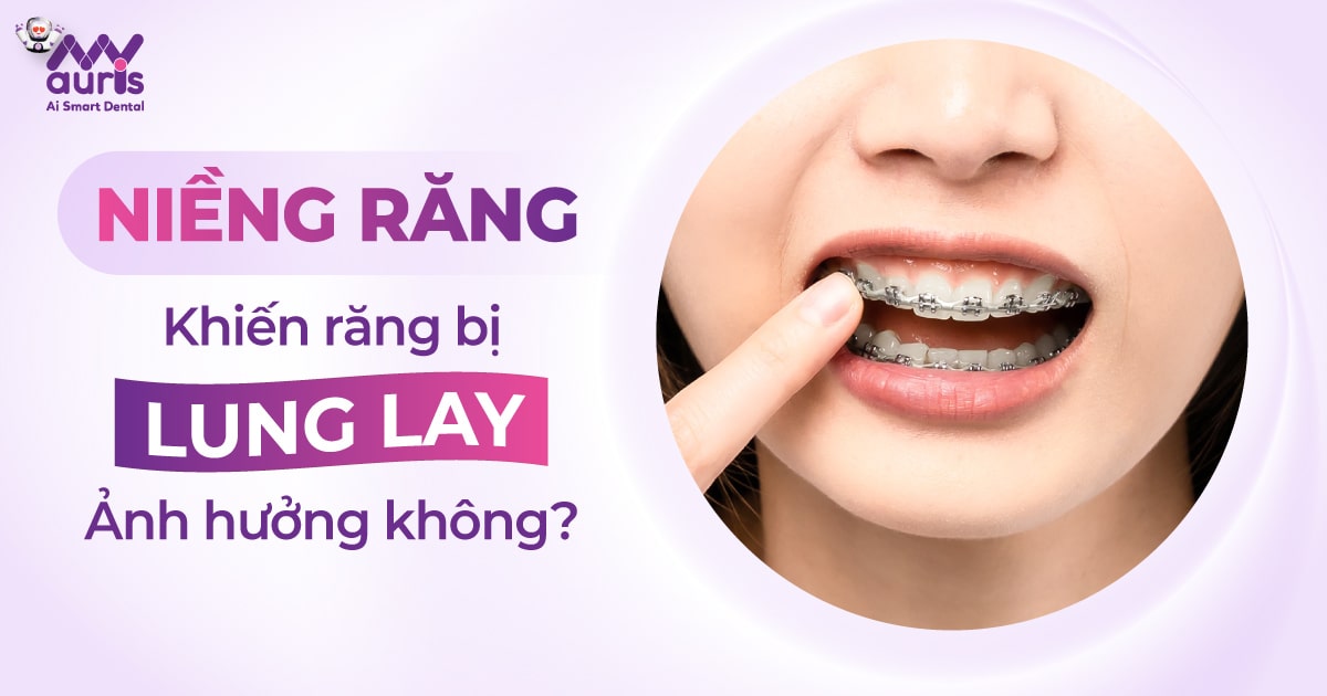 Niềng răng khiến răng bị lung lay ảnh hưởng không?