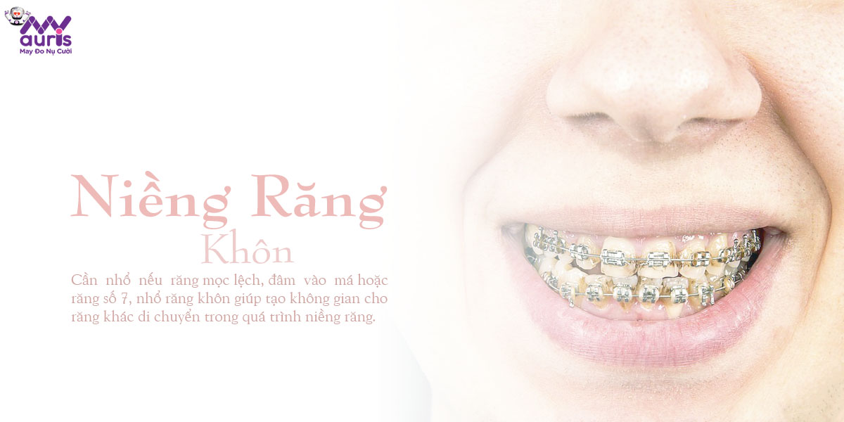 niềng răng khôn