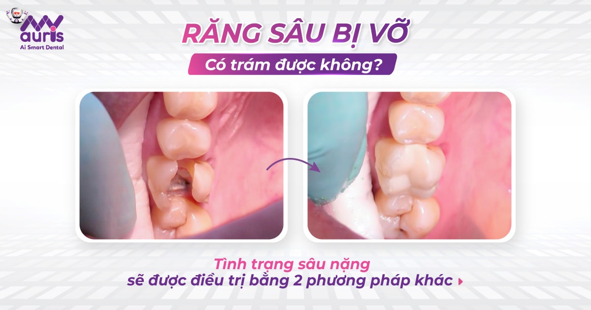 Răng sâu bị vỡ có trám được không