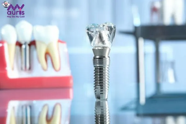 Tư vấn sau khi nhổ răng bao lâu thì cấy Implant được?