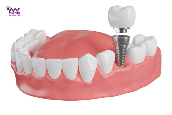  trồng răng hàm implant giá bao nhiêu 