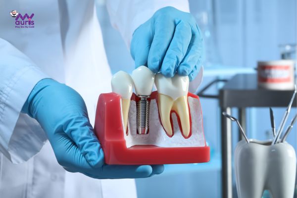  trồng răng hàm implant giá bao nhiêu 