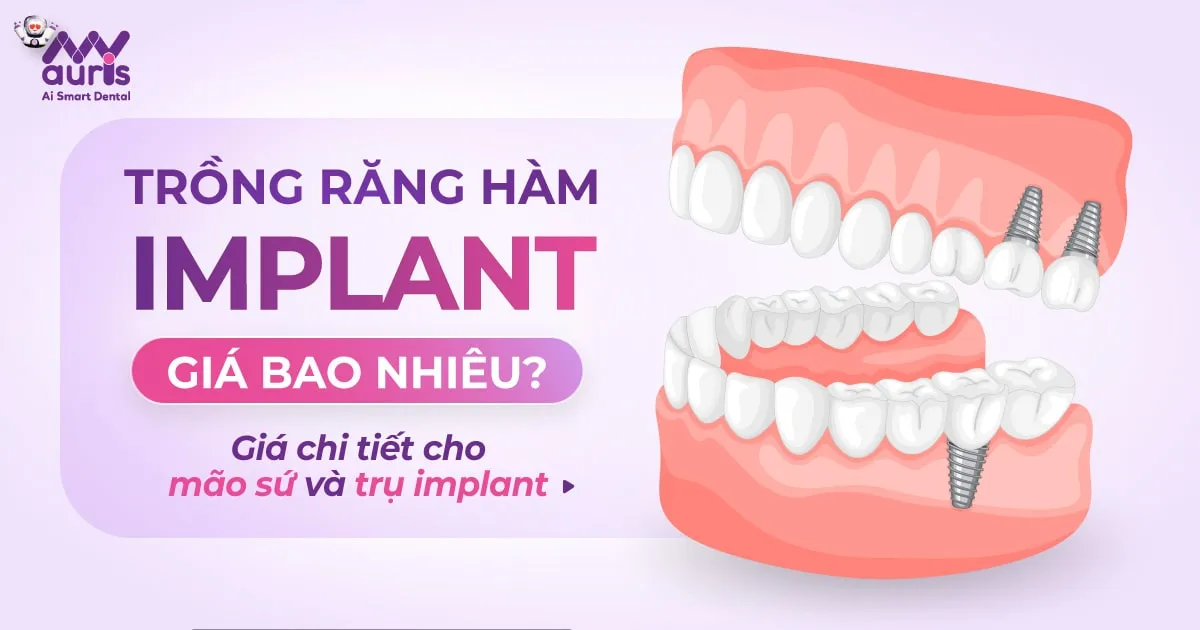 Trồng răng hàm implant giá bao nhiêu
