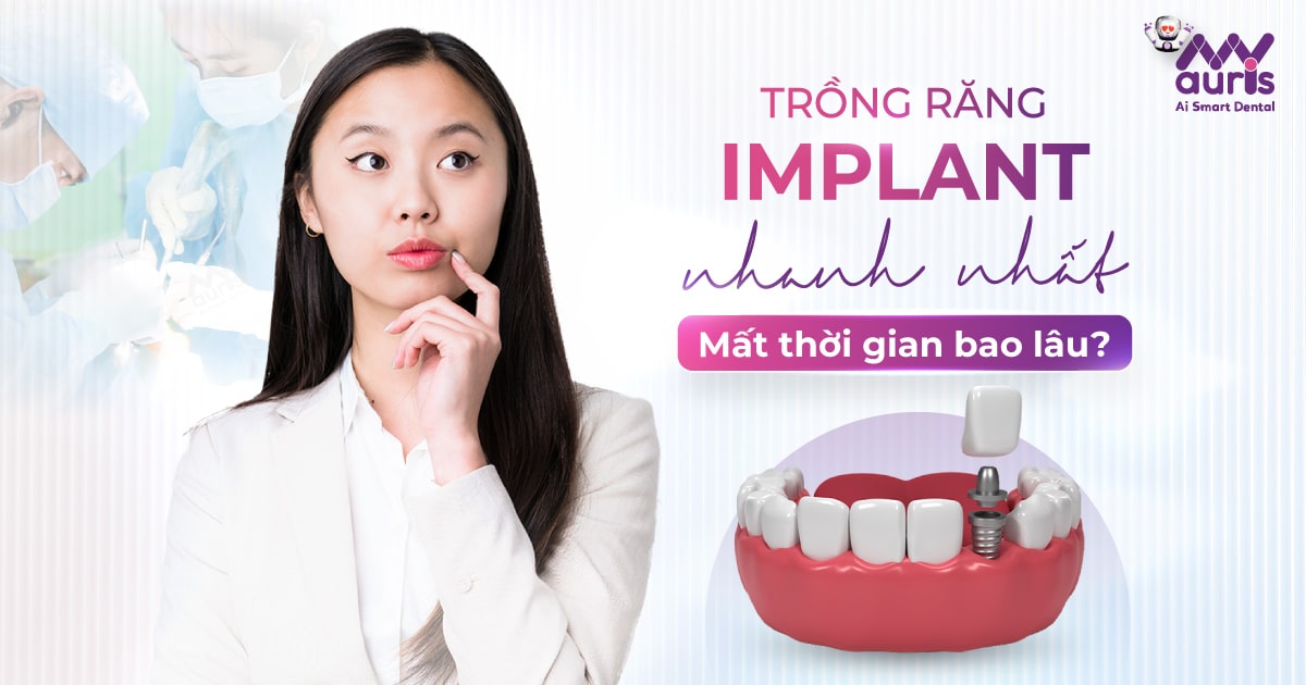 Trồng răng implant nhanh nhất mất thời gian bao lâu?