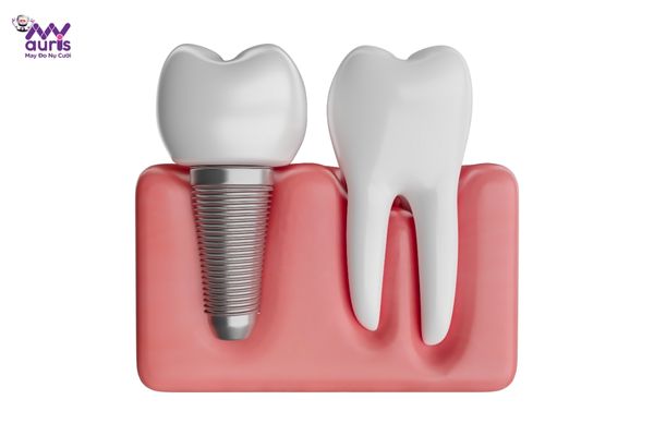 trồng răng implant ở đâu tốt nhất 