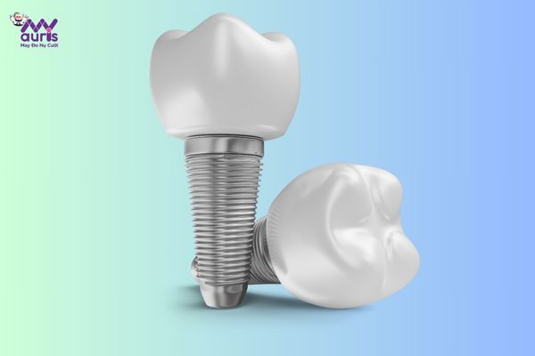  trồng răng implant ở đâu tốt nhất 