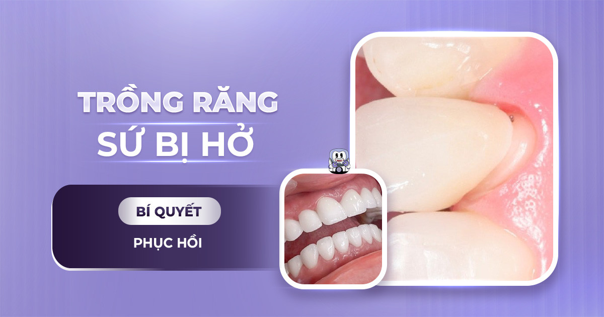 trồng răng sứ bị hở,làm răng sứ bị hở chân răng