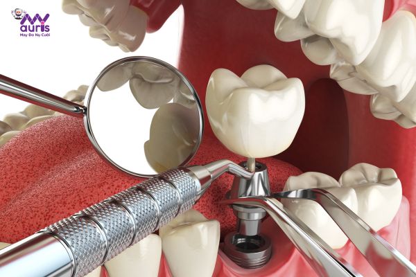 trồng răng implant giá bao nhiêu tiền 
