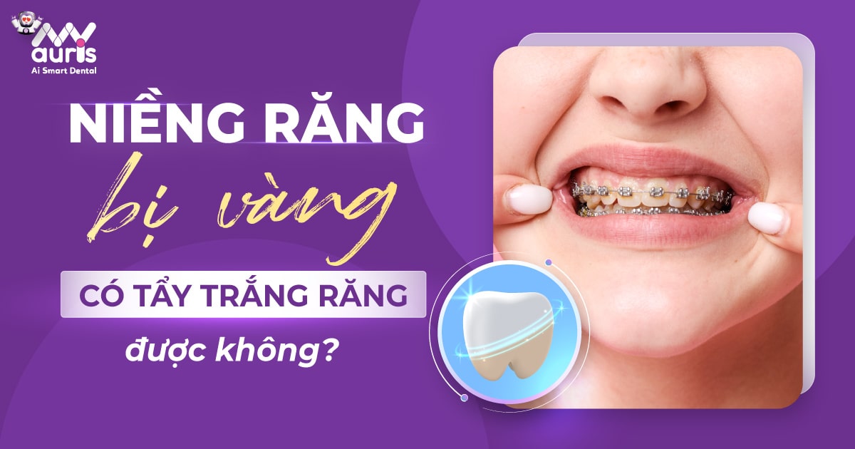 niềng răng bị vàng