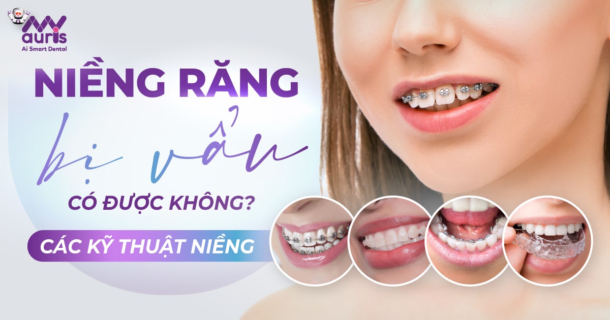 niềng răng bị vẩu