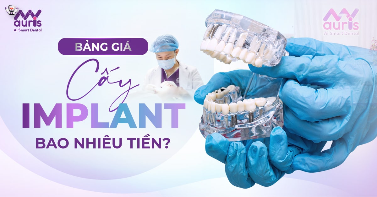 bảng giá cấy implant