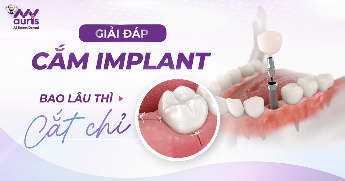 cắm implant bao lâu cắt chỉ