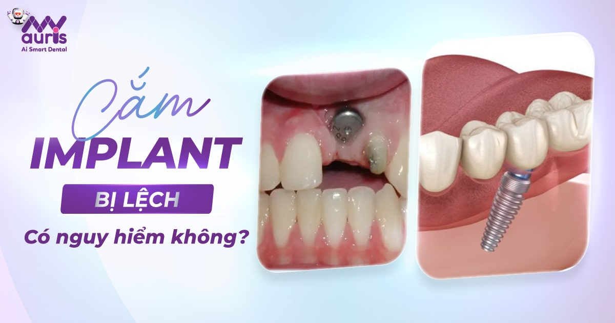 cắm implant bị lệch