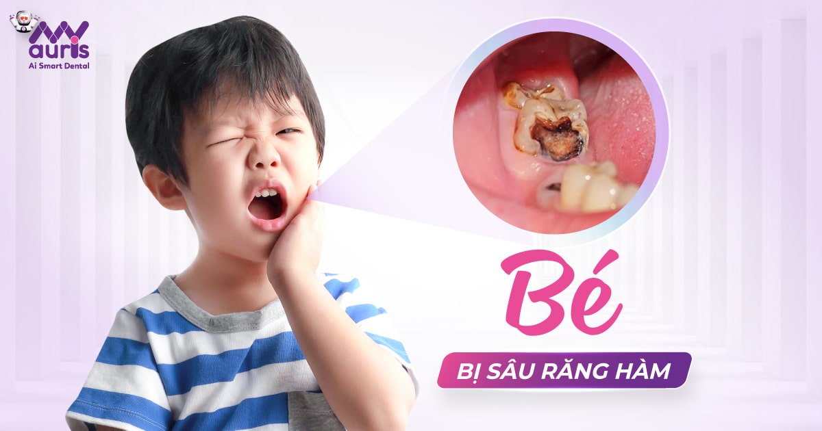 Bé bị sâu răng hàm - 4 nguyên nhân ảnh hưởng phổ biến