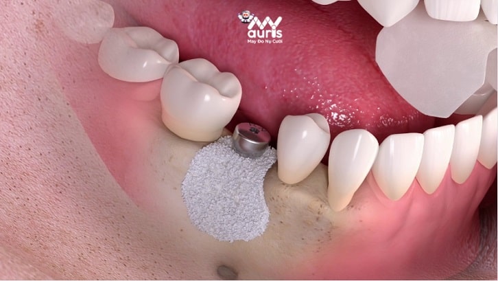 cách chăm sóc răng sau khi cắm implant