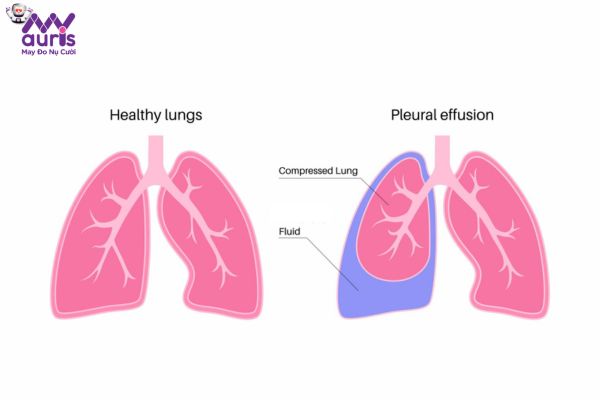 Giải đáp các cách điều trị tràn dịch màng phổi tại nhà