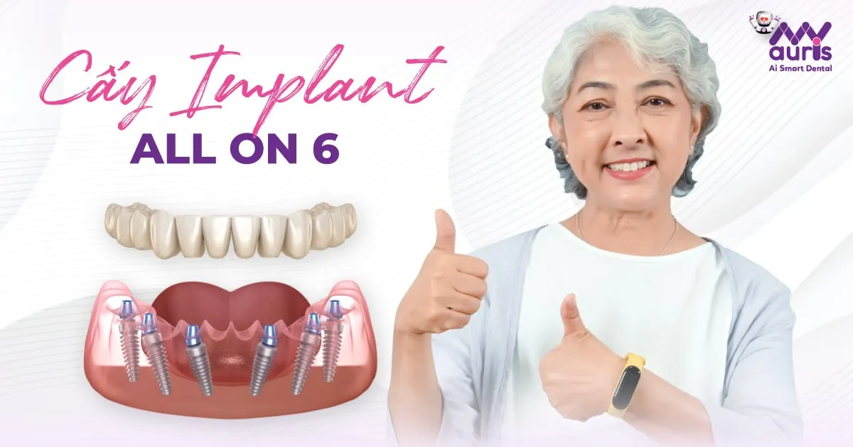 Cấy ghép Implant All On 6 - Tại sao nên thực hiện?