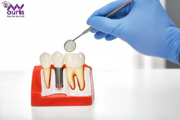 Giải đáp cấy Implant bao lâu thì gắn răng sứ?