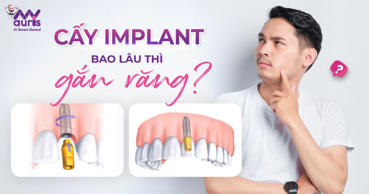 Cấy Implant bao lâu thì gắn răng - 5 yếu tố quyết định