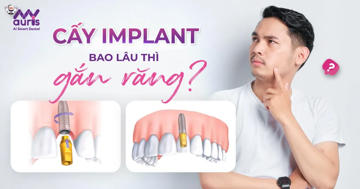 Cấy Implant bao lâu thì gắn răng - 5 yếu tố quyết định