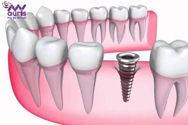 Chi tiết 3 giai đoạn chính trong trồng răng Implant với thời gian thực hiện 