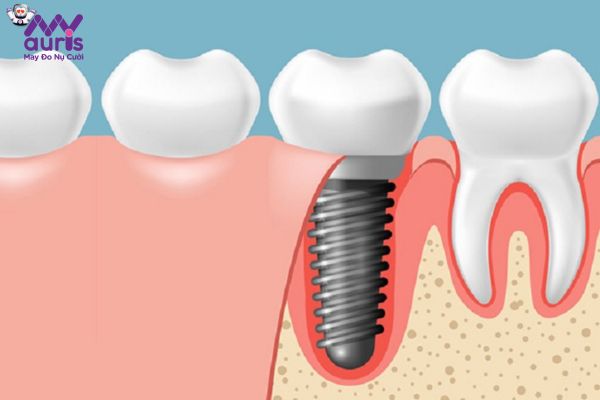 Giải đáp cấy răng Implant mất thời gian bao lâu?