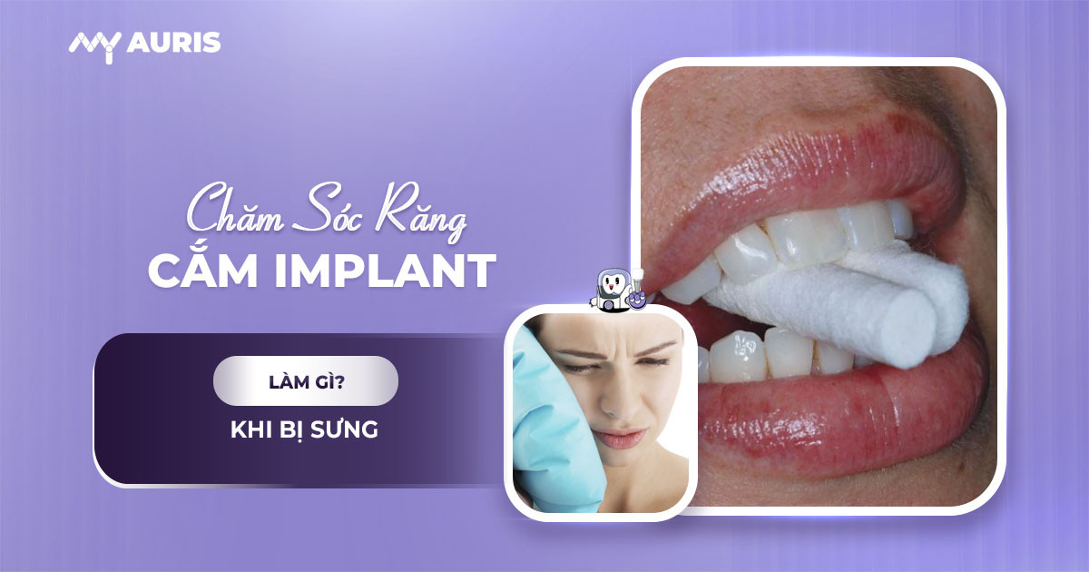chăm sóc răng sau khi cắm implant,chăm sóc sau cấy implant