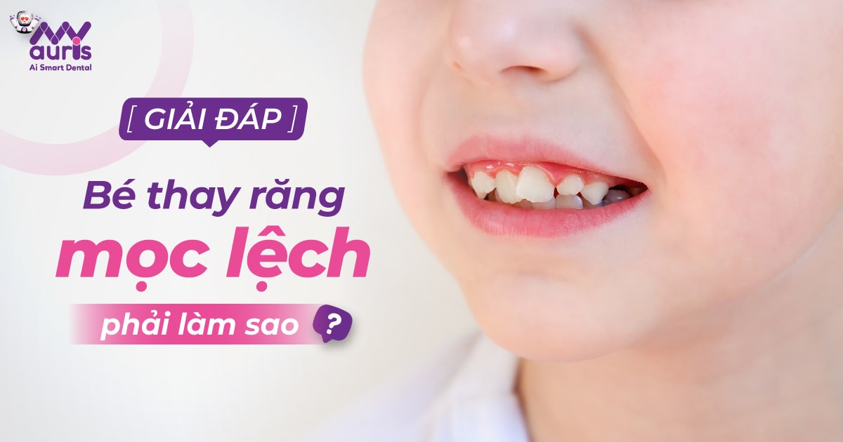 Bé thay răng mọc lệch phải làm sao?