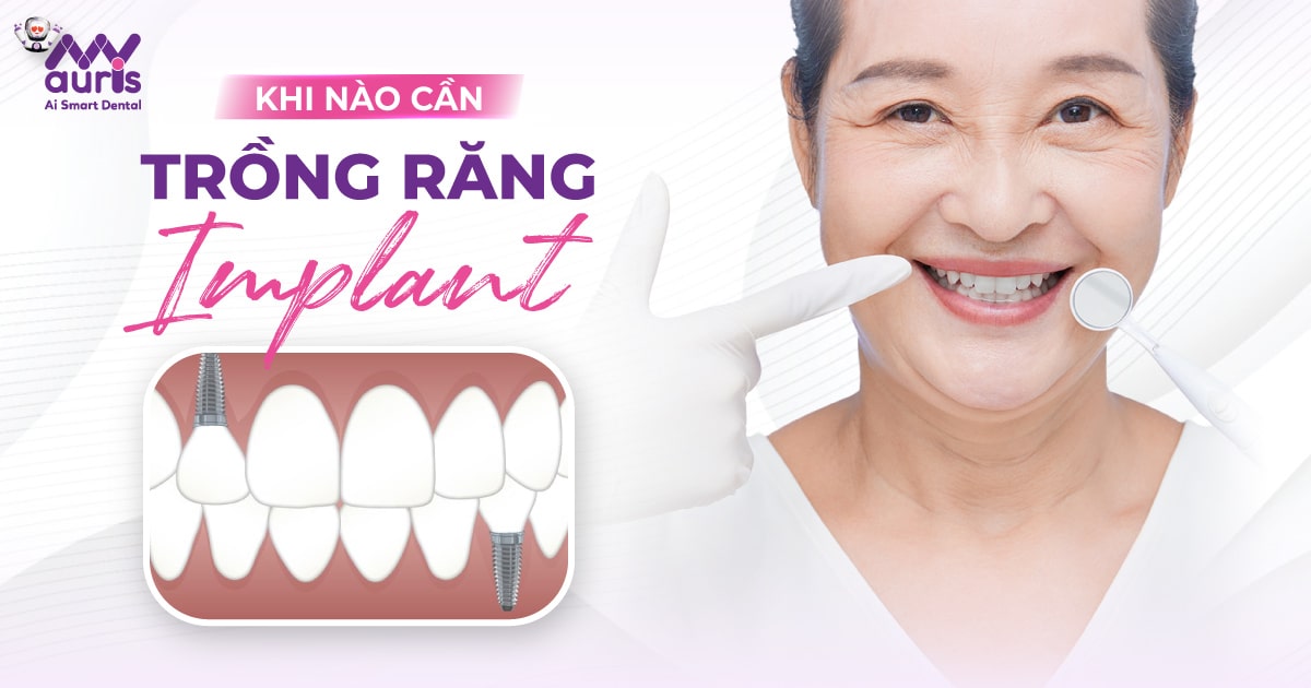 Khi nào cần cấy Implant - 8 bước thực hiện phục hình